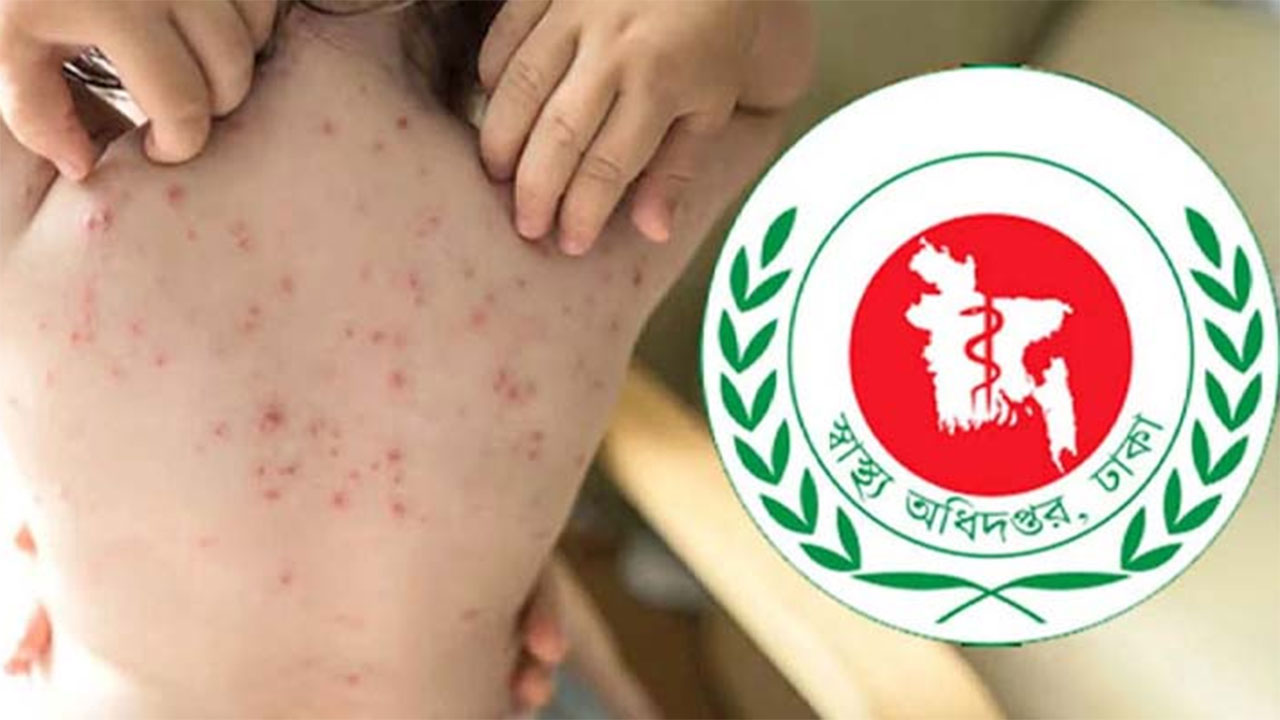 ২৪ ঘণ্টায় হাম ও উপসর্গে আরও ৫ জনের মৃত্যু